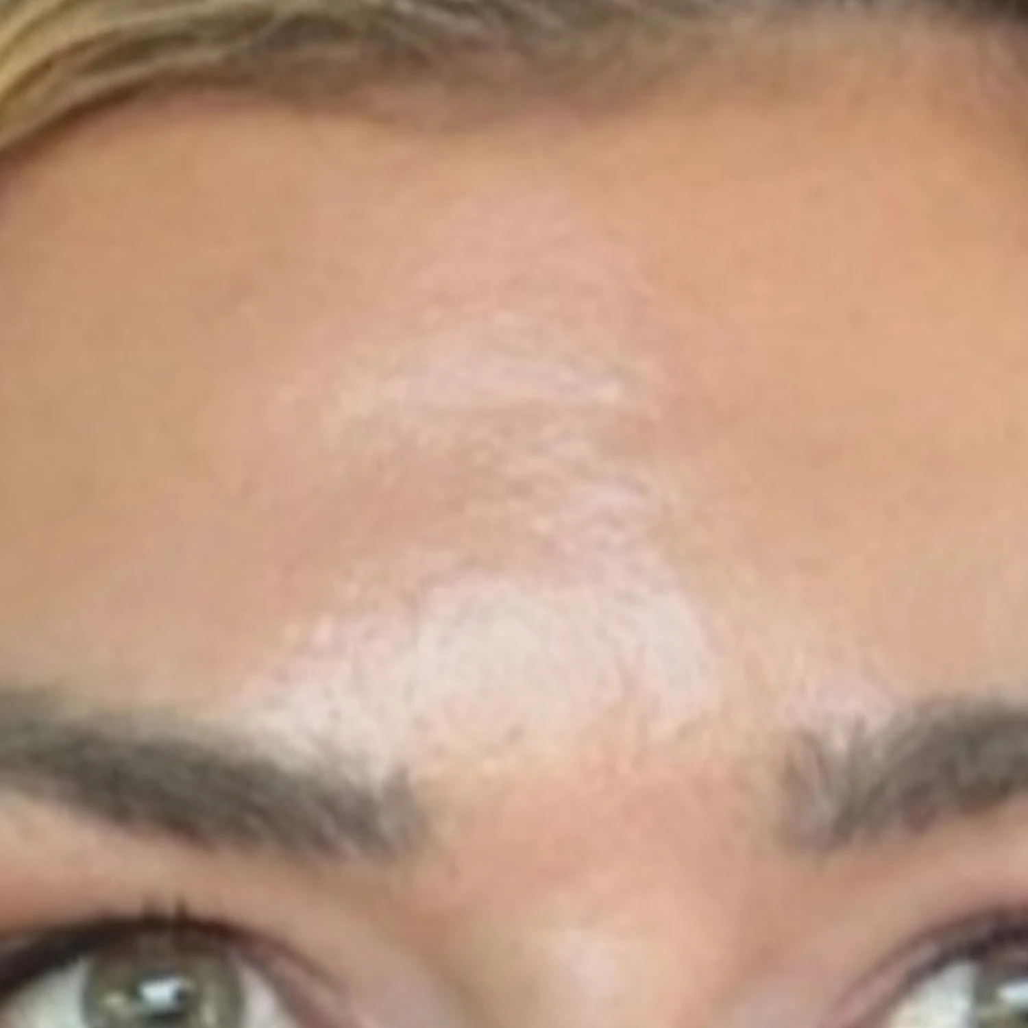 After &mdash; forehead smoothing with neuromodulator, by Valerie Villegas, PA-C