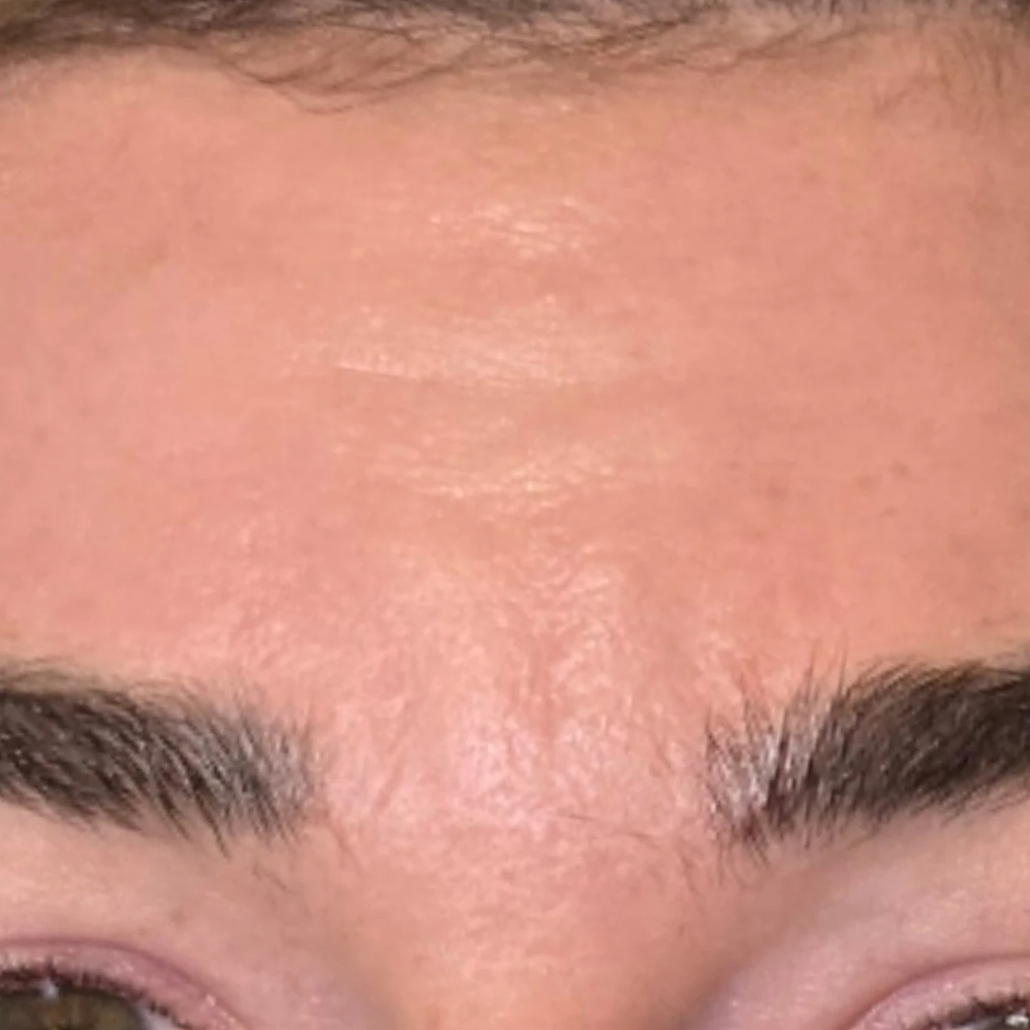 Before &mdash; forehead smoothing with neuromodulator, by Valerie Villegas, PA-C