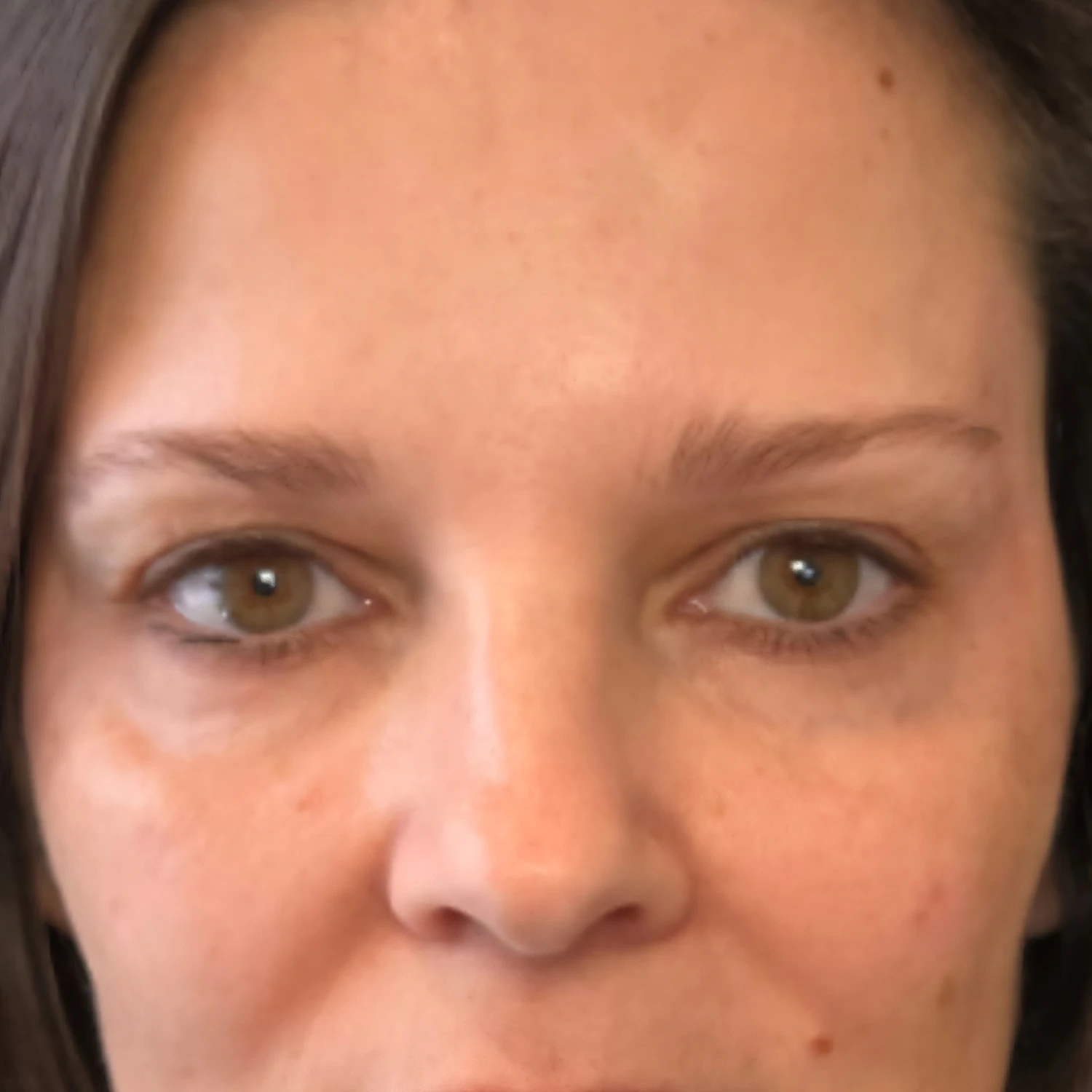 After &mdash; under-eye and facial rejuvenation, by Valerie Villegas, PA-C