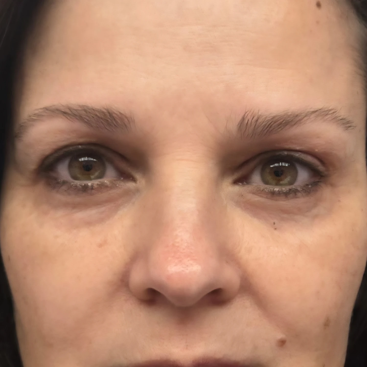 Before &mdash; under-eye and facial rejuvenation, by Valerie Villegas, PA-C