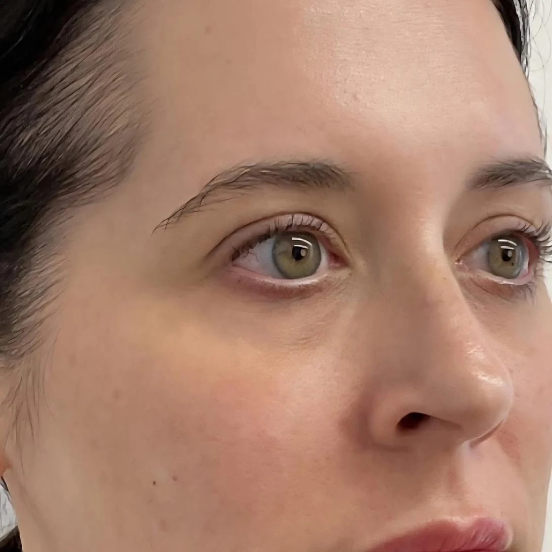 After &mdash; under-eye and facial rejuvenation, by Valerie Villegas, PA-C