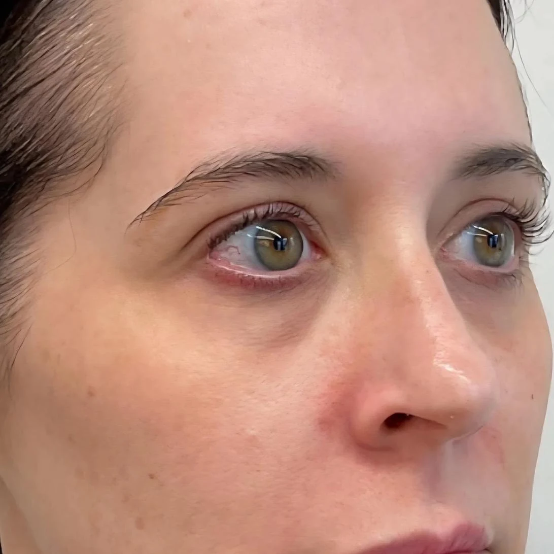 Before &mdash; under-eye and facial rejuvenation, by Valerie Villegas, PA-C